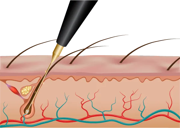 Electrolysis hair removal