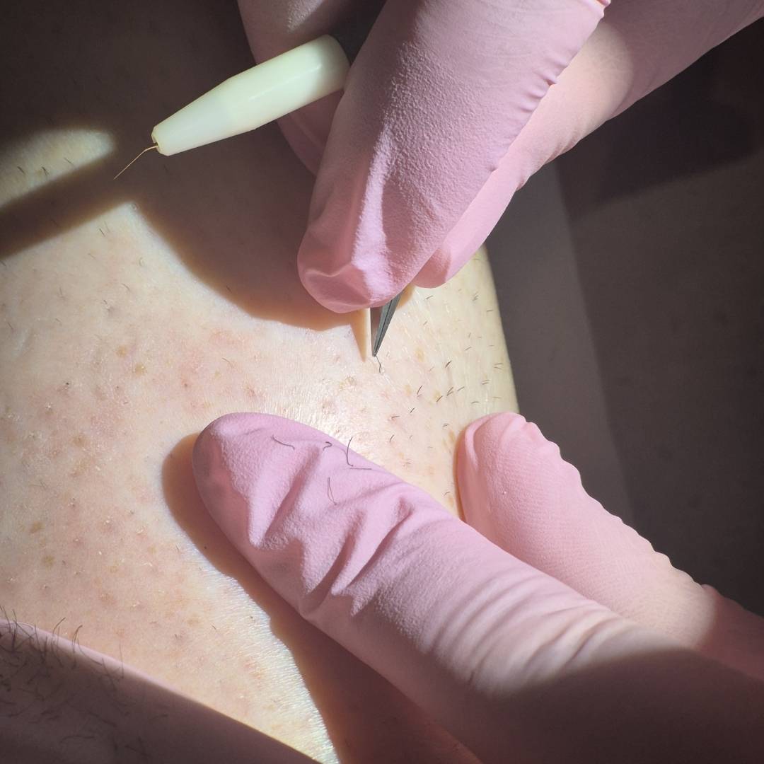 Body electrolysis treatment